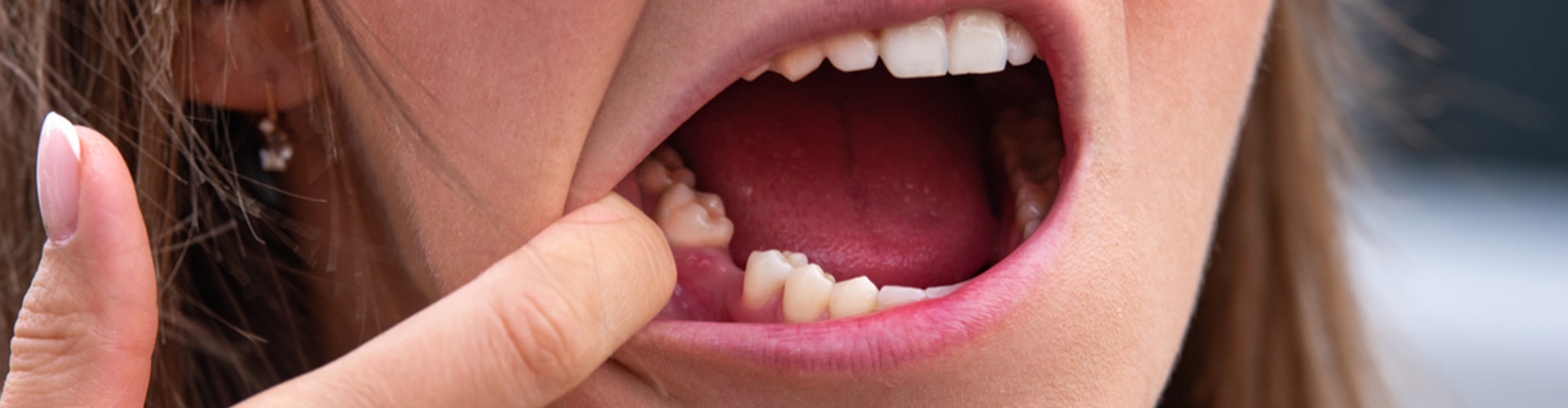 Girl holding mouth opened with one tooth missing.