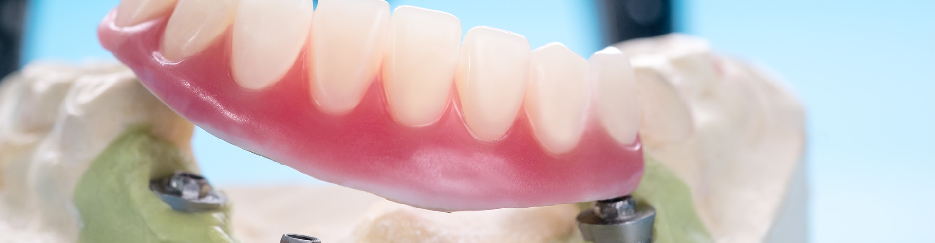 implant-retained denture over model of jaw with 4 implants.