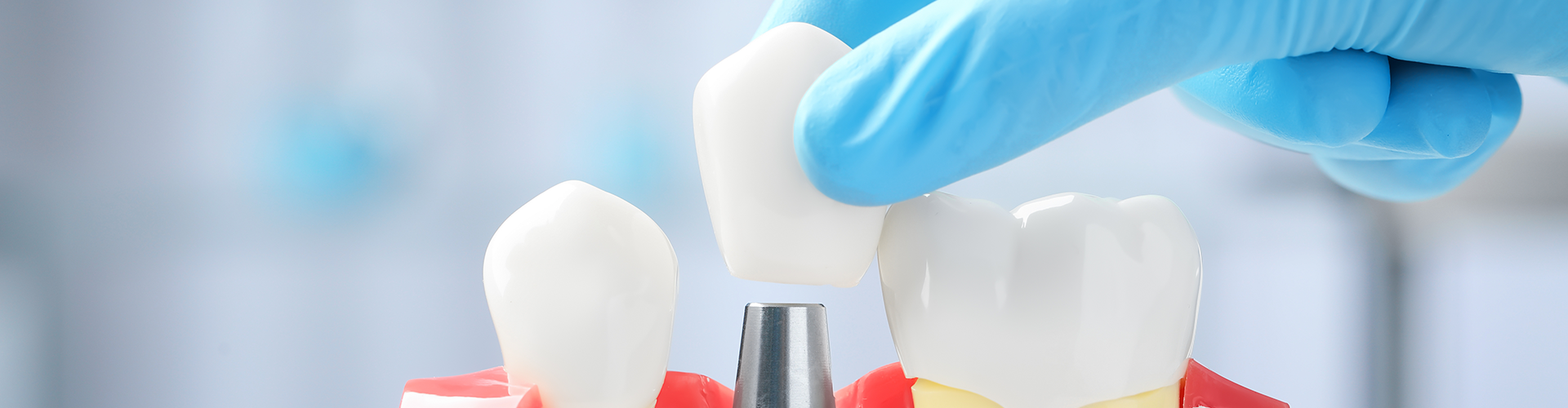 gloved hand placing a dental crown on an implant model.