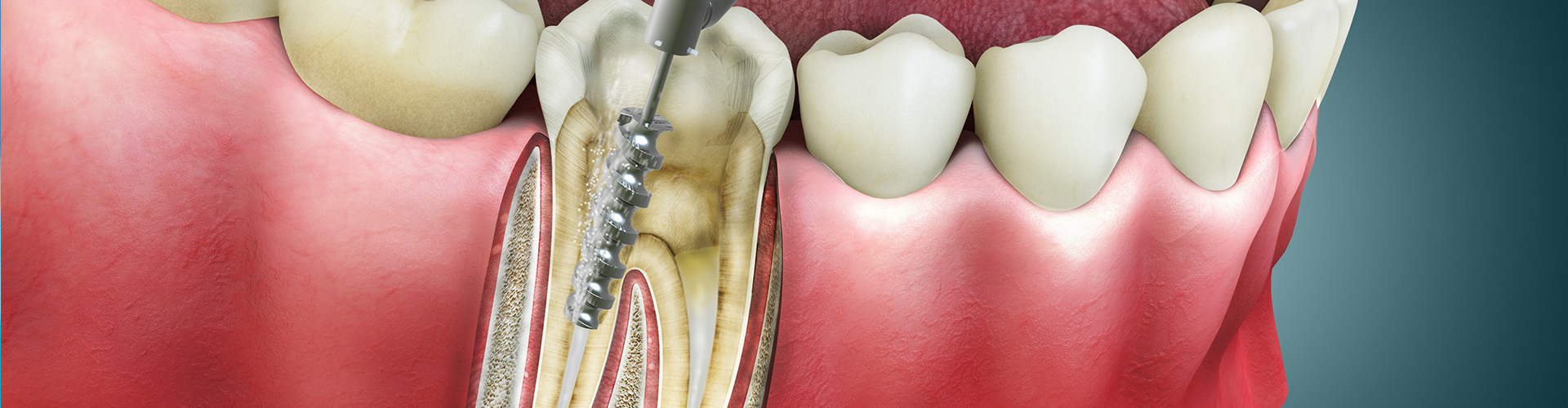 rendering of a dental tool inside a root canal of a tooth.