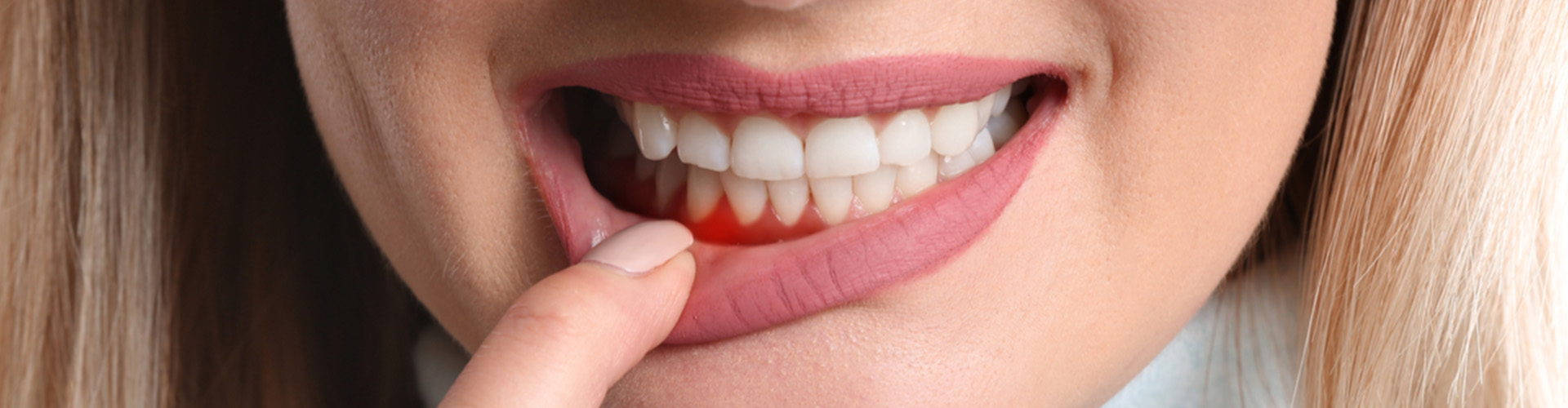 woman pulling down lip to show red gums.