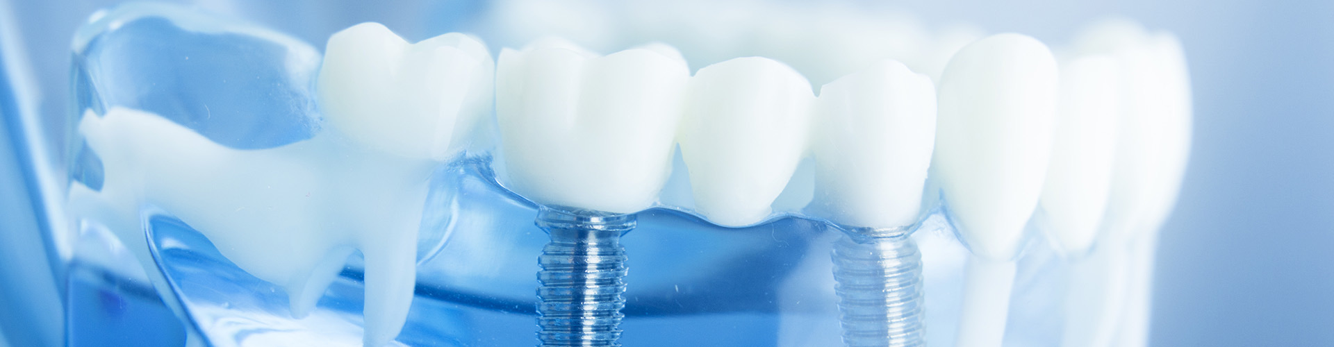 transparent model of a jaw with a dental implant and crown.