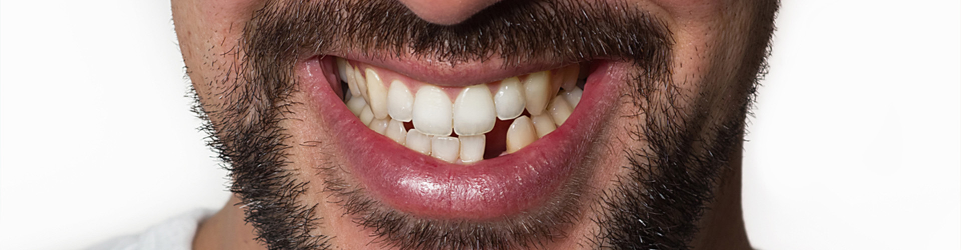 Smile with a missing tooth.