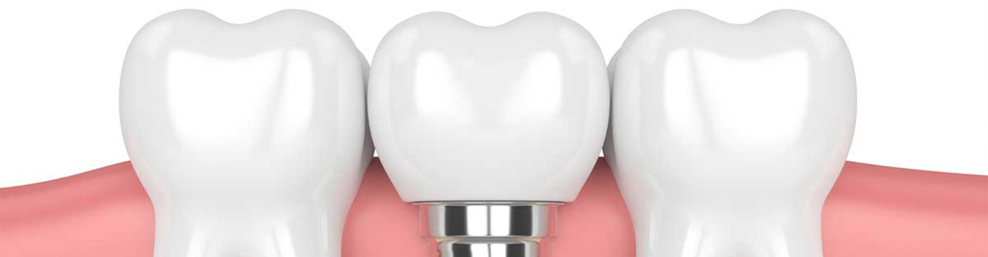 Animated image of three teeth, one showing screw in the gums.