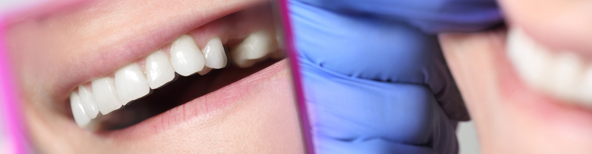 Man looking in the mirror with one tooth missing.