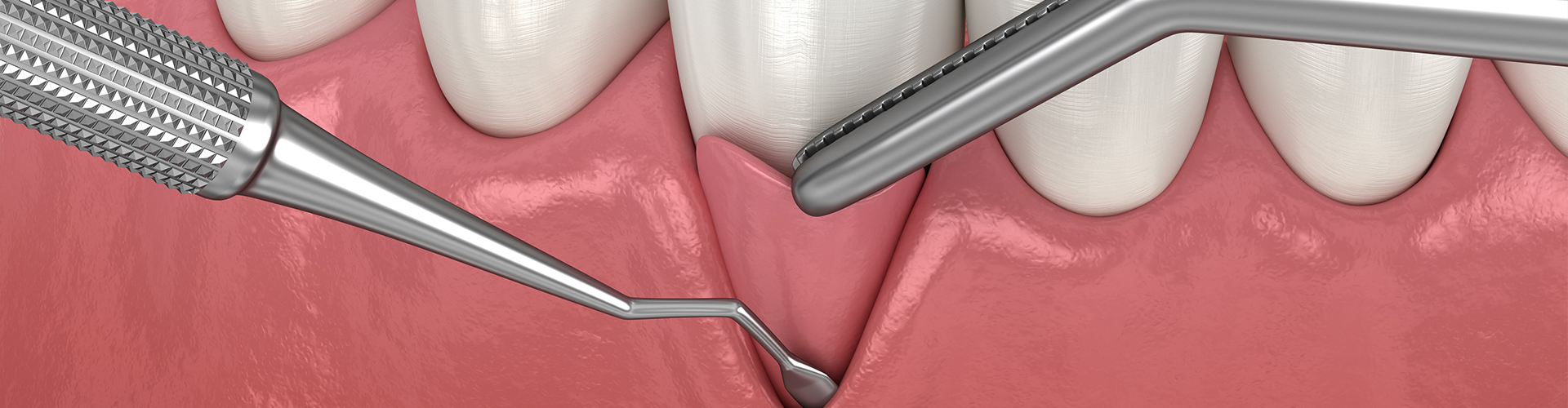 rendering of a gum graft being placed.