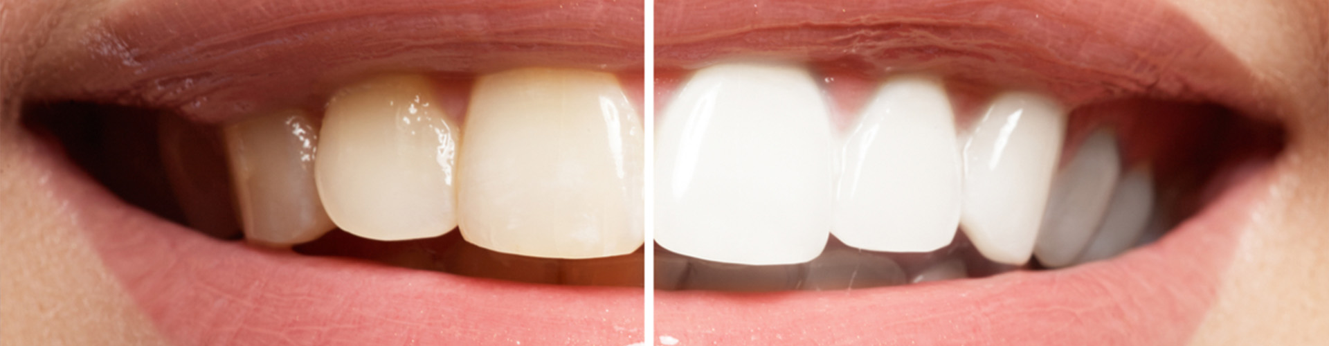 Smile two sides half white and half yellow.
