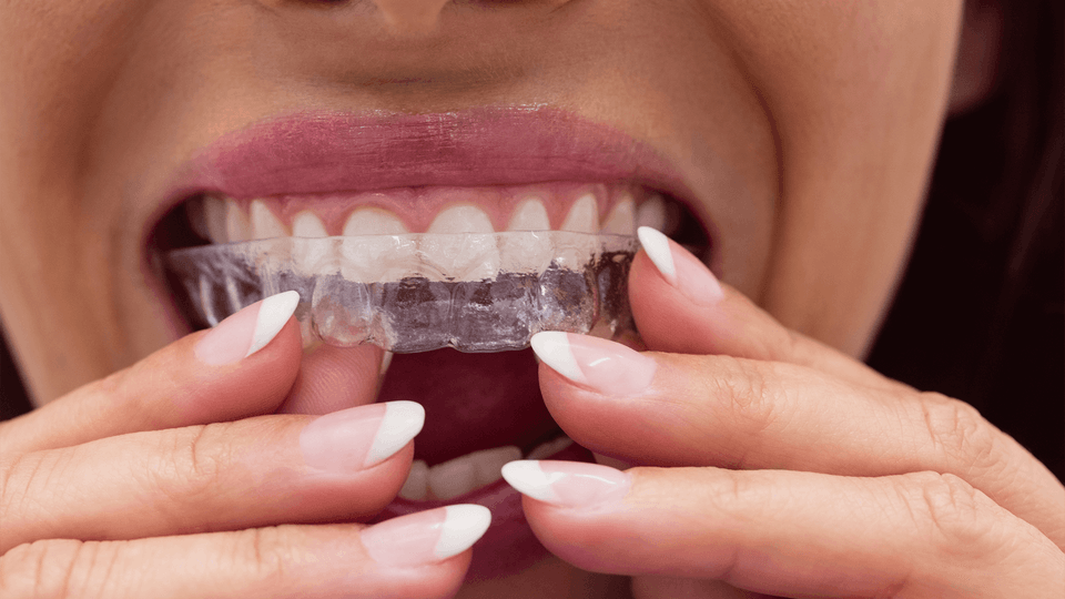 Invisalign Can Straighten Your Teeth and Enhance Your Smile in ...