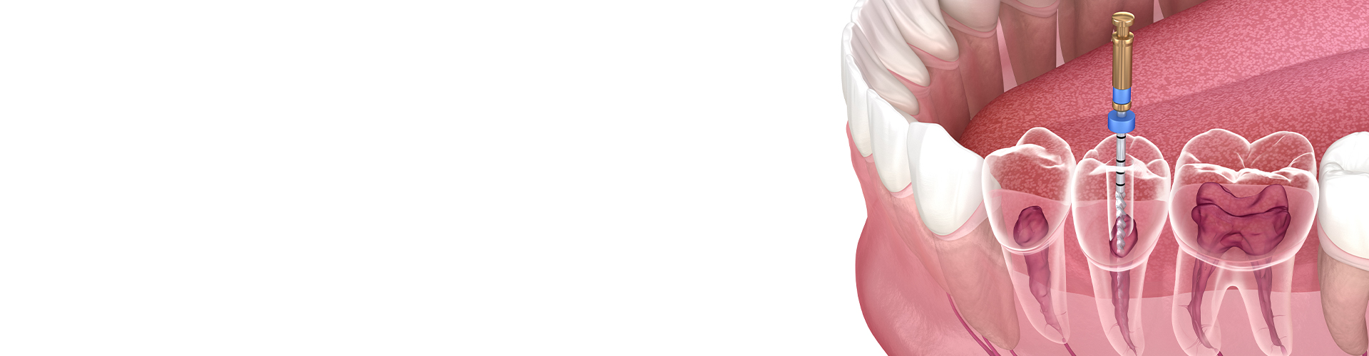 rendering of a lower jaw with a tooth getting root canal therapy.