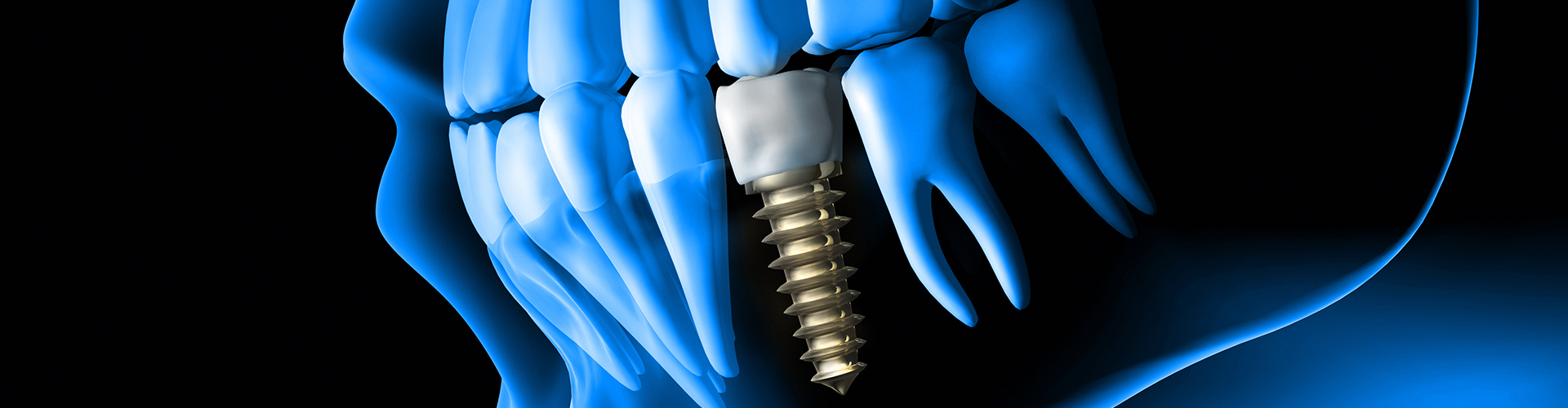 rendering of an implant in an x-ray of a head.