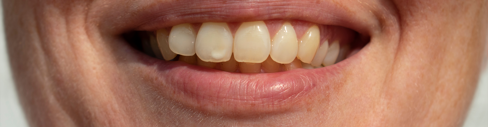 woman smiling with yellowed teeth.