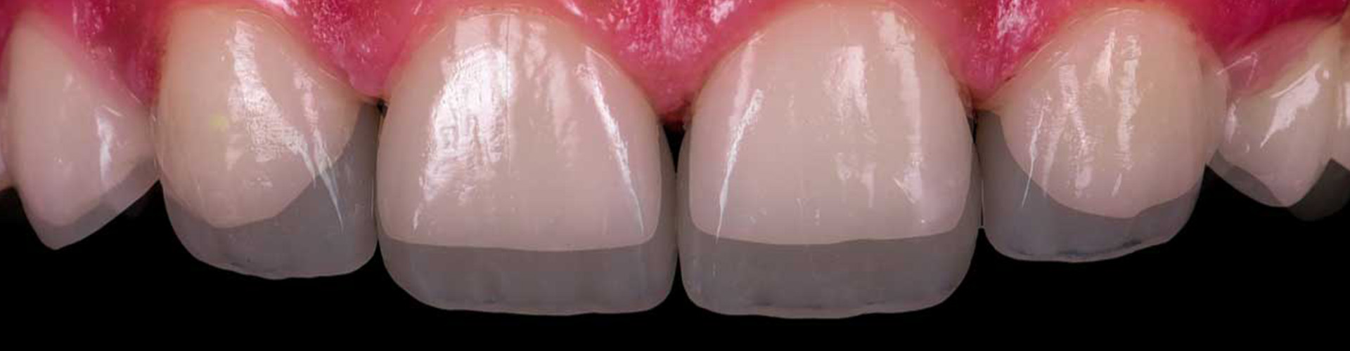 tooth transition when bonding is added.