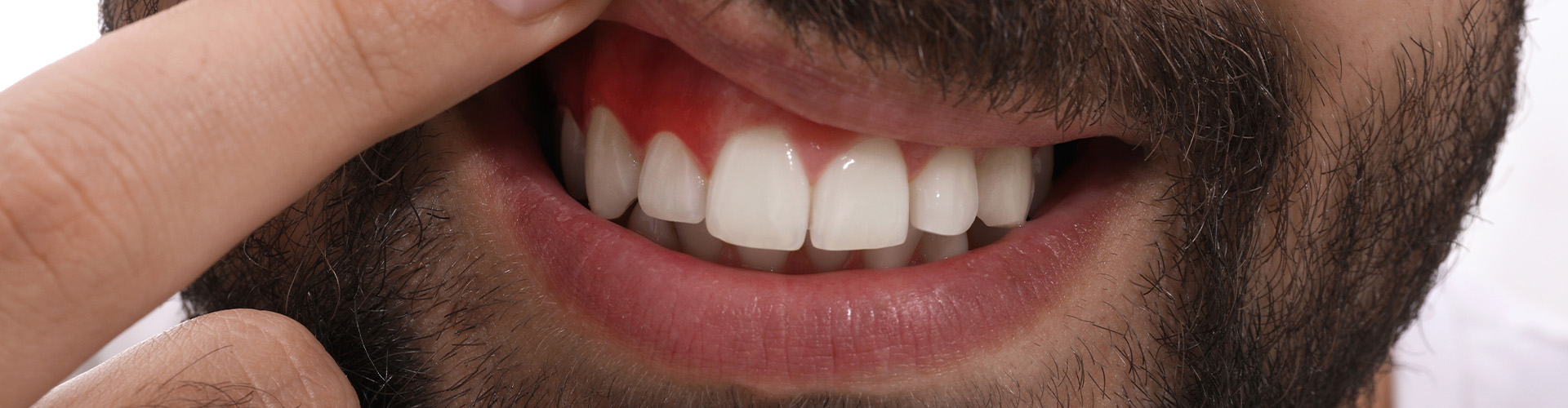 man lifting lip to show inflamed gum.