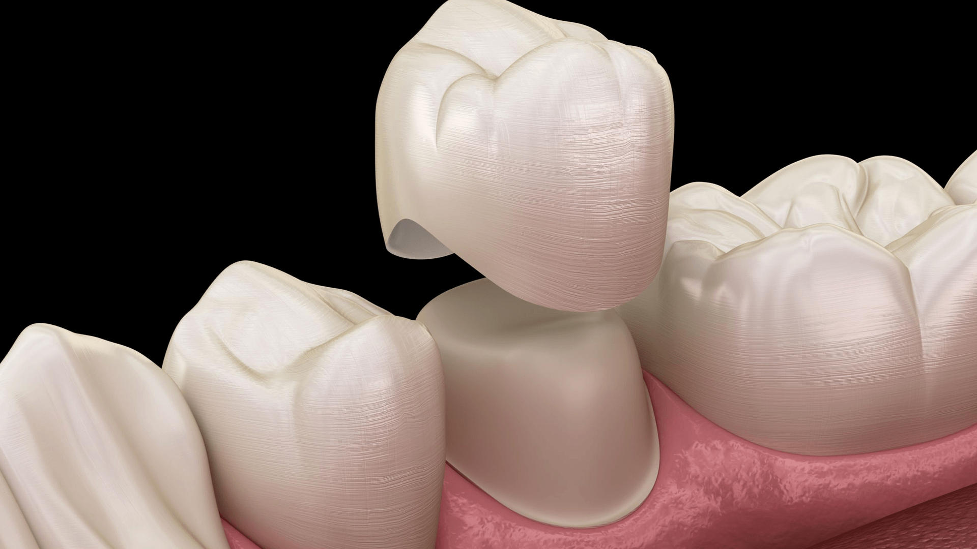 Crown fitting where it goes.