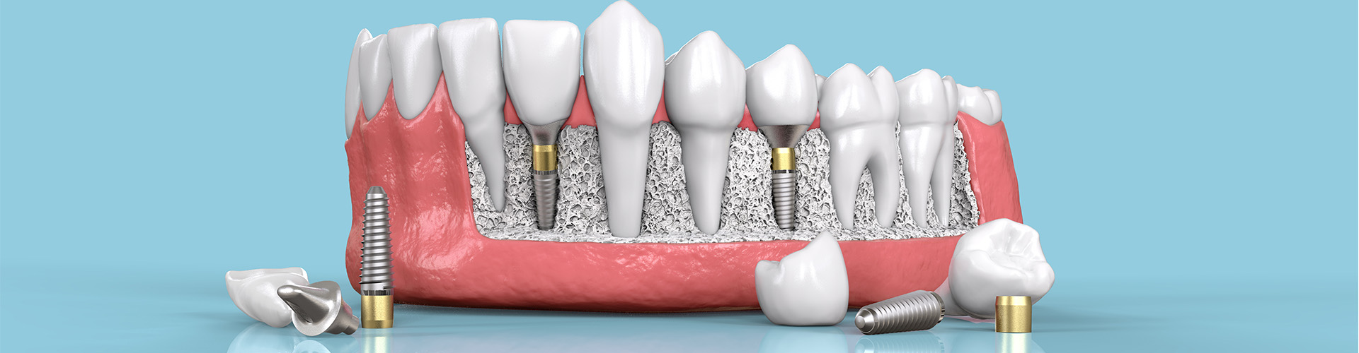 rendering of dental implants and natural teeth in a lower jaw.