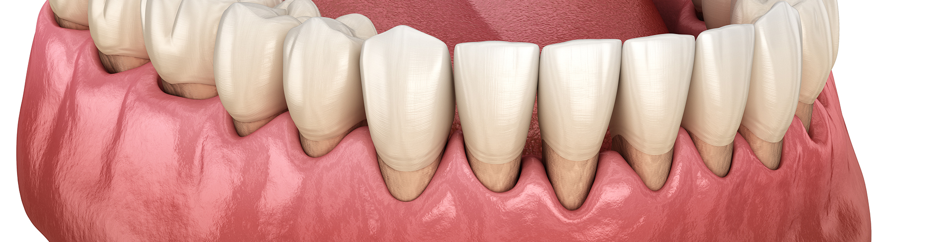 rendering of teeth with receding gums.