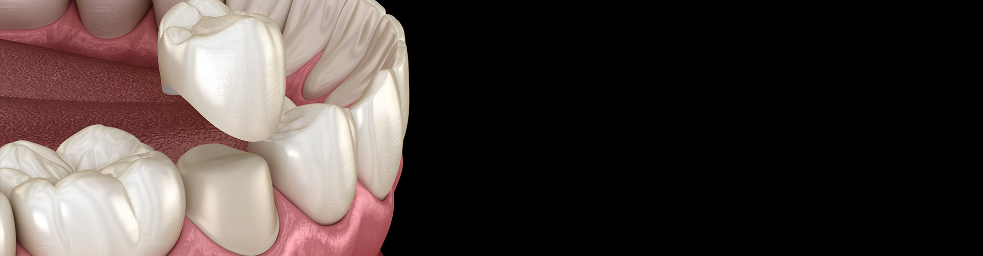 rendering of a tooth receiving a dental crown.