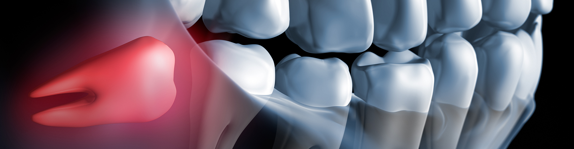 rendering of a mouth with a red impacted wisdom tooth.