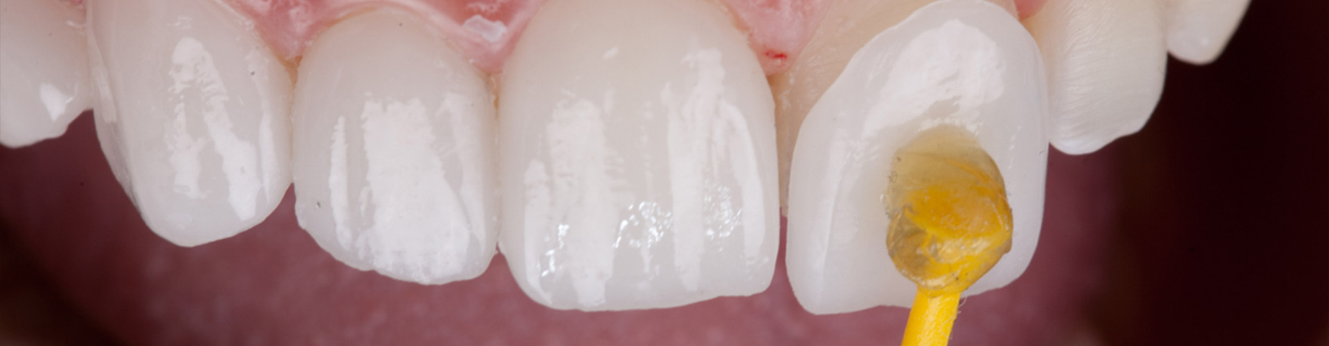 Gluing a Lumineers on to a tooth.