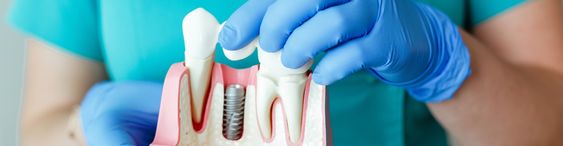 Display of teeth one with screw in it.