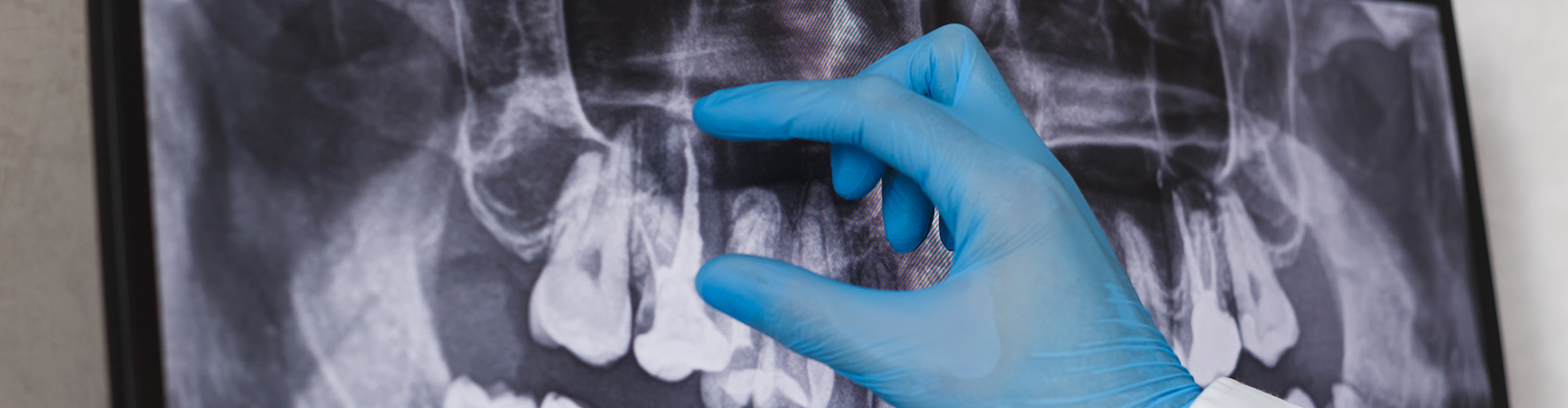 gloved hand in front of a dental x-ray.