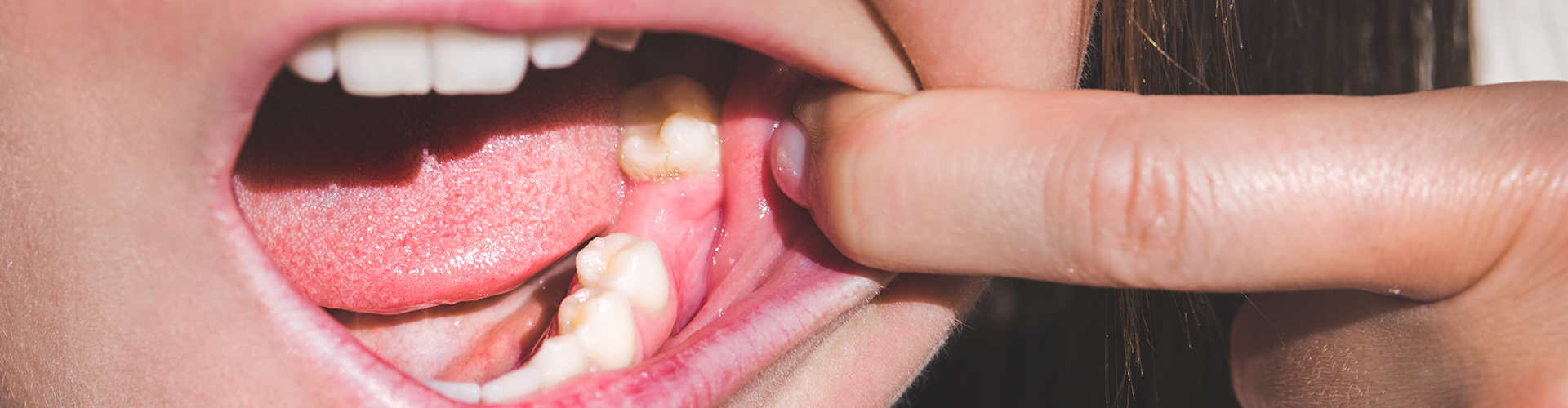 woman pulling cheek aside to reveal tooth gap.