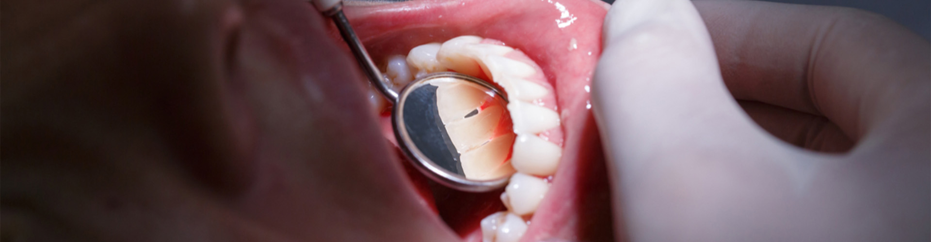 Mouth opened with dentist putting small mirror behind teeth.