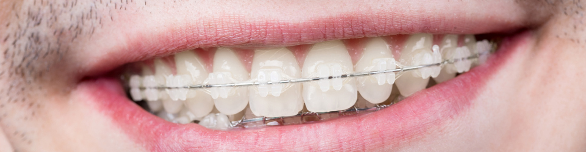 Man smiling with metal braces.