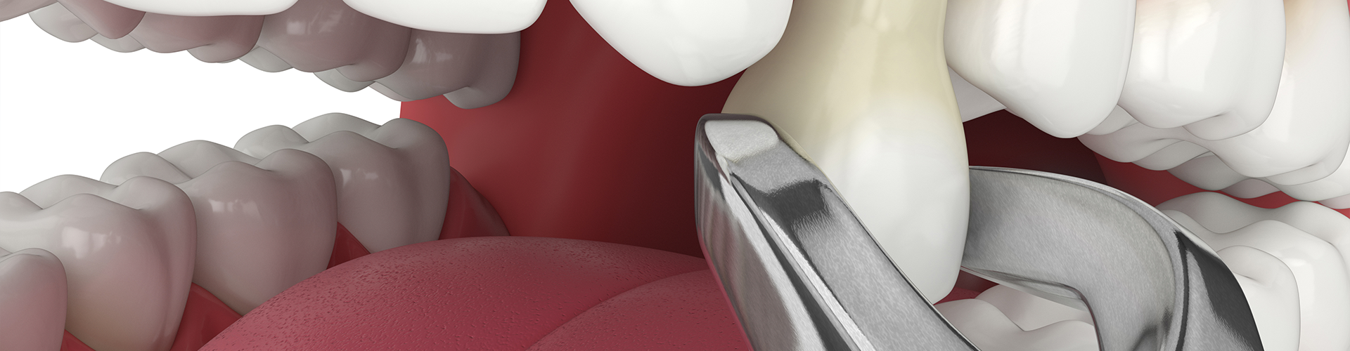 rendering of pliers removing a tooth from gums.