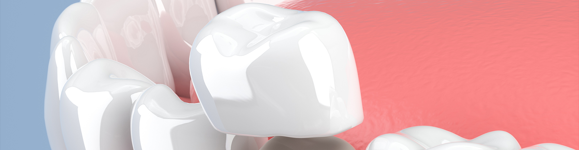 rendering of a dental crown being placed on a filed-down tooth.