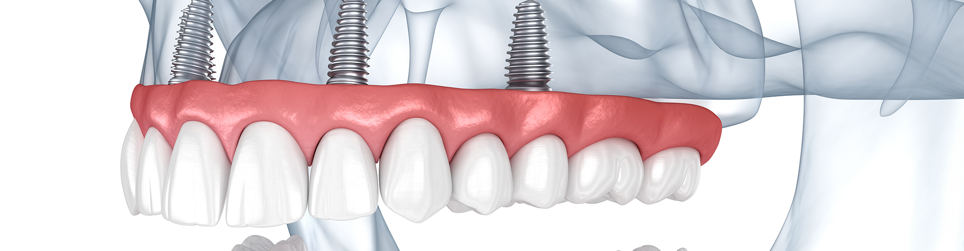 rendering of upper and lower implant-retained dentures in skull.