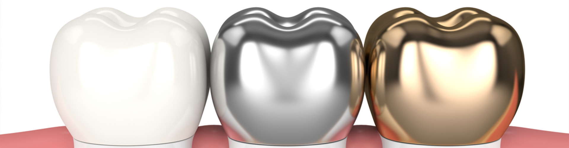 rendering of porcelain, metal, and gold crowns.