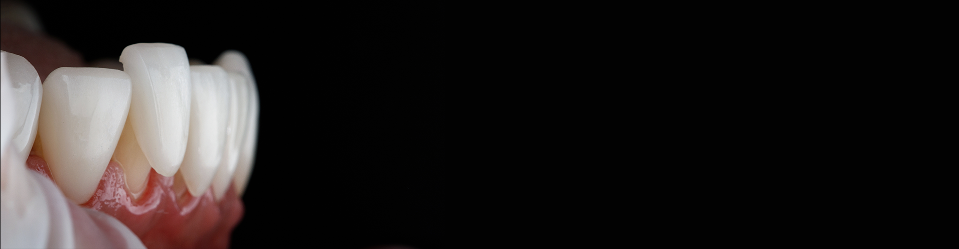 image of veneers being fitted over teeth in mouth model.