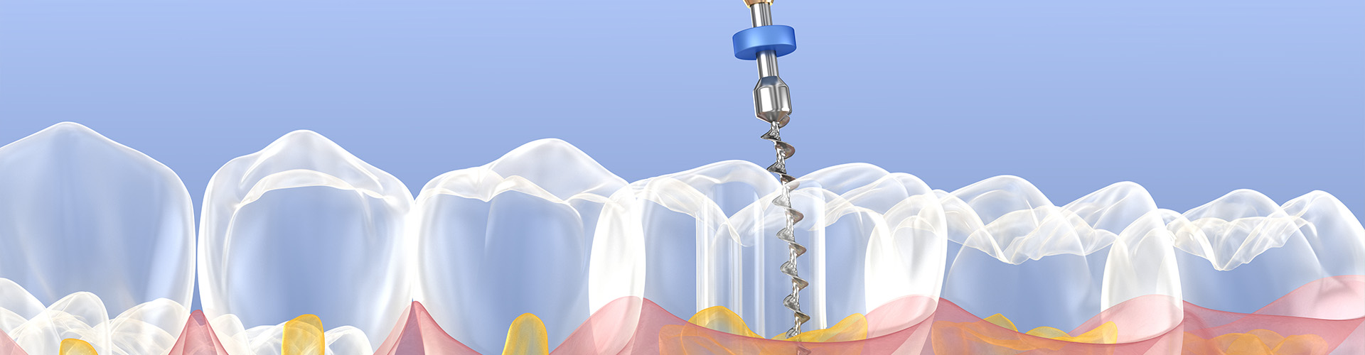 rendering of root canal therapy being performed on transparent teeth.